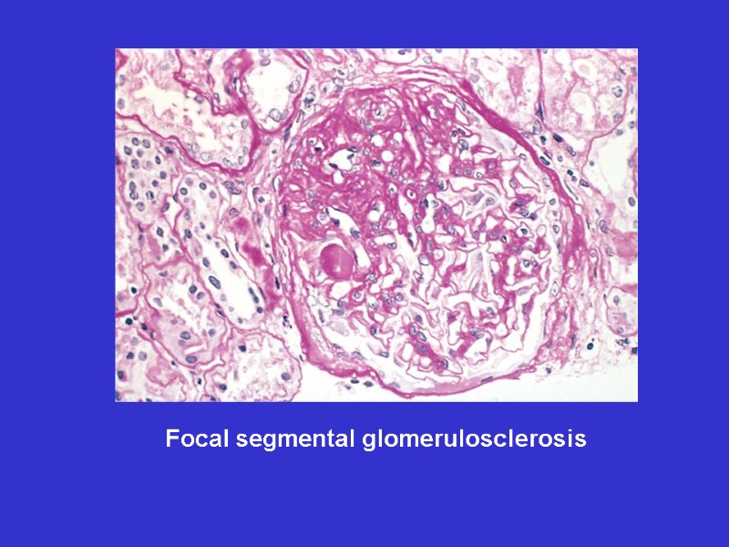 Focal segmental glomerulosclerosis